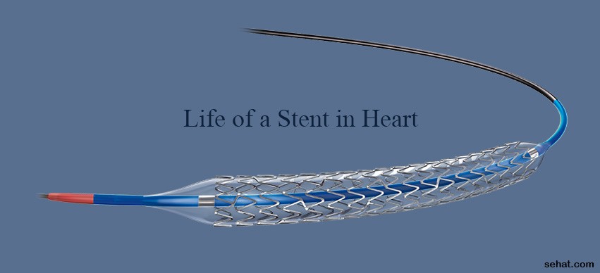 How Long Does Urinary Stent Pain Last? Solutions Inside