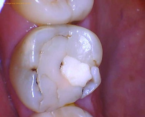 How Long Should Fillings Hurt