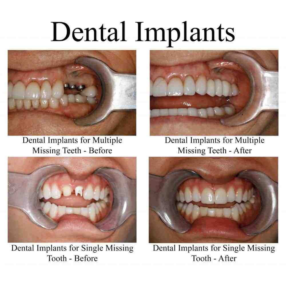 How Much Do Dental Implants Cost For One Tooth? Affordable Options