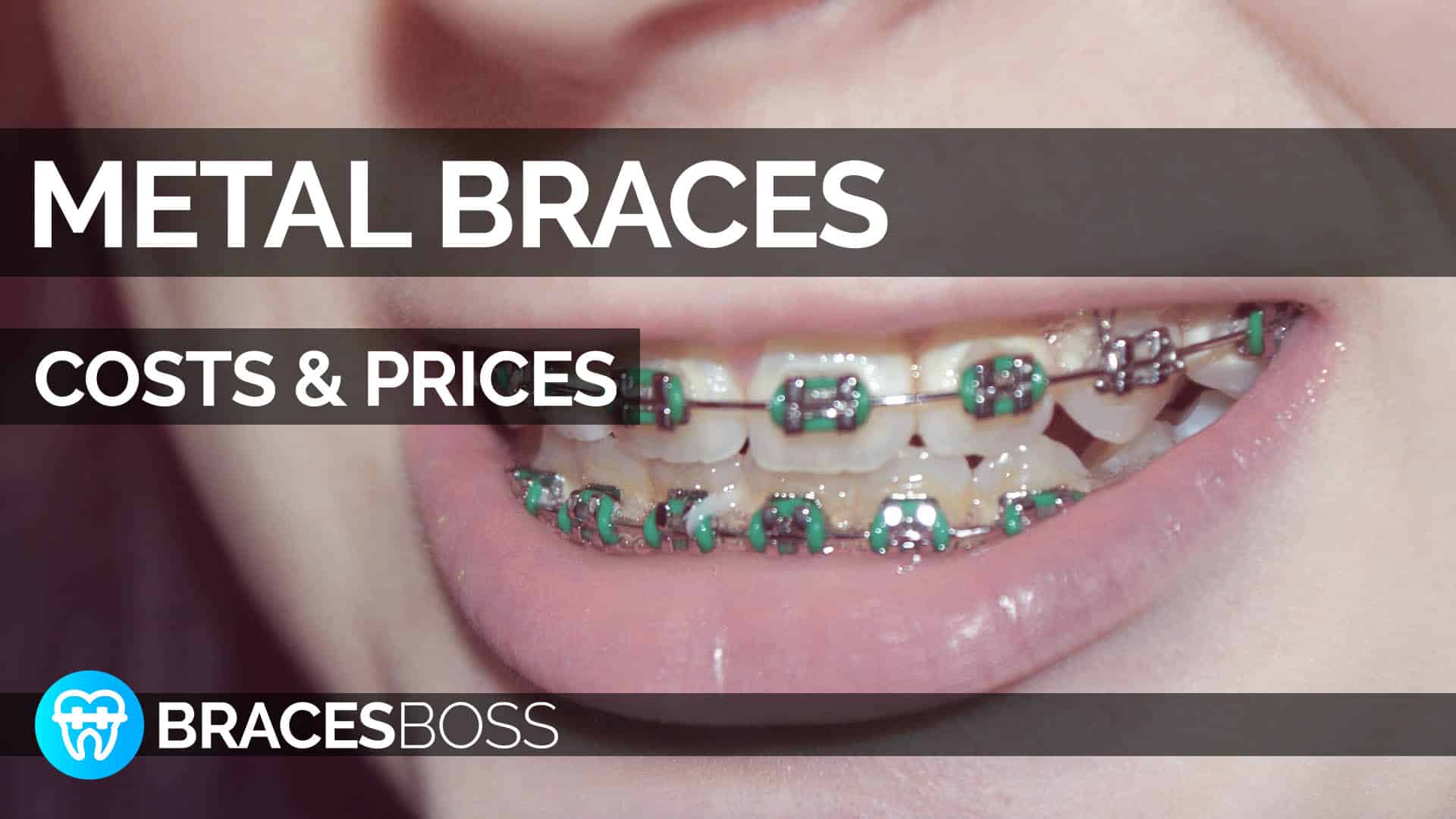 How Much For Metal Braces