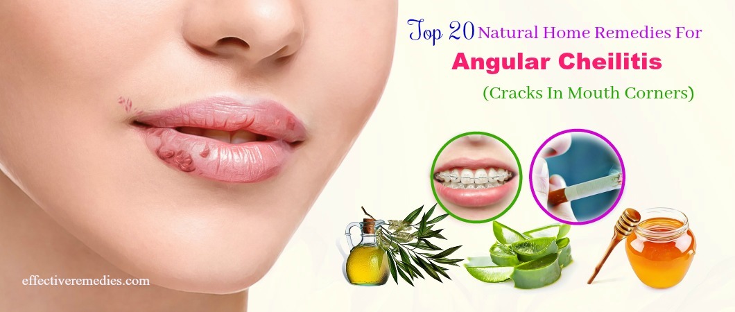 How To Cure Angular Cheilitis? Uk Remedies
