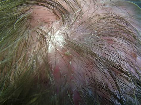 How To Cure Foliculite Do Couro Cabeludo? Natural Remedies