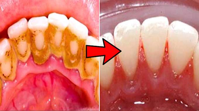 How To Enlever Le Tartre Des Dents? Easy Removal Tips
