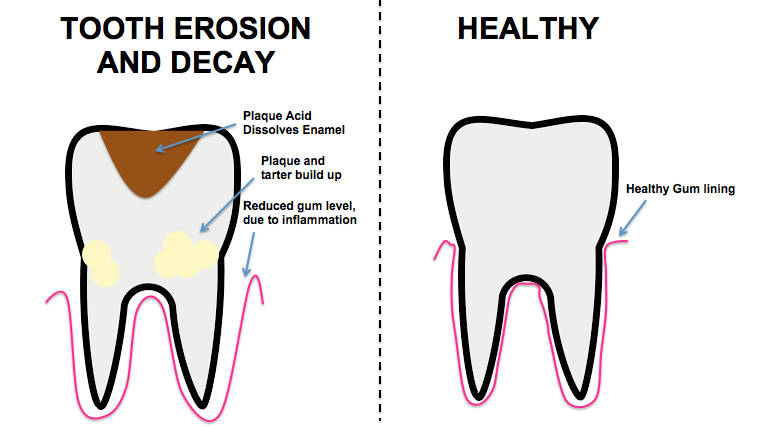 How To Fill Cavity In Front? Tooth Repair Guide How To Fill Cavity In Front? Tooth Repair Guide