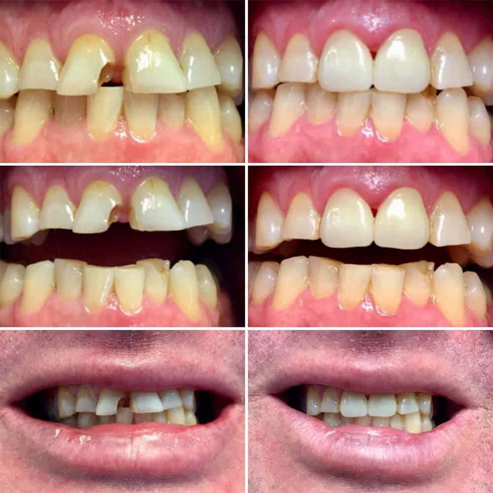 How To Fix Broken Teeth? Fast Relief Options