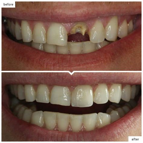 How To Fix Broken Tooth Near Me? Sameday Repair