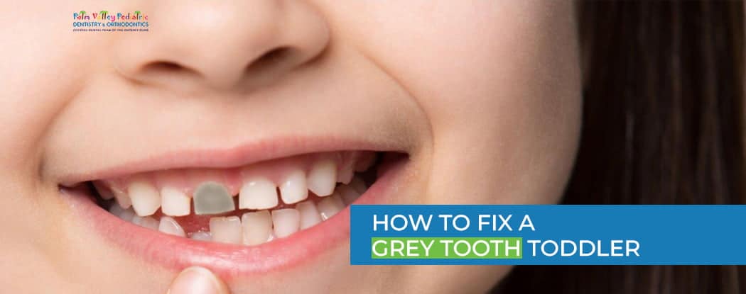 How To Fix Grey Tooth? Get Expert Help