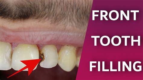 How To Fix Indentations On Teeth? Easy Repair Tips