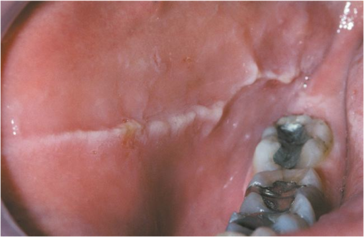 How To Fix Linea Alba Mouth? Natural Remedies