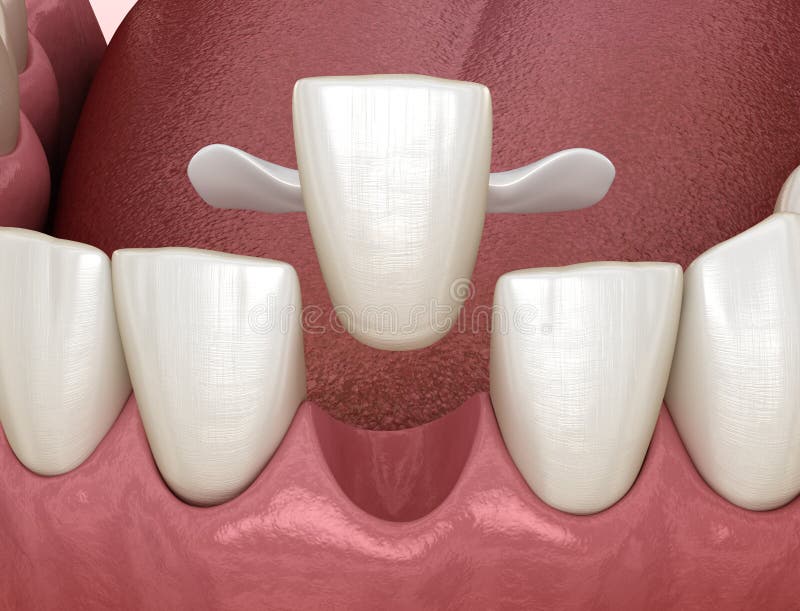 How To Get A Bridge For Front Tooth? Easy Fix Guide