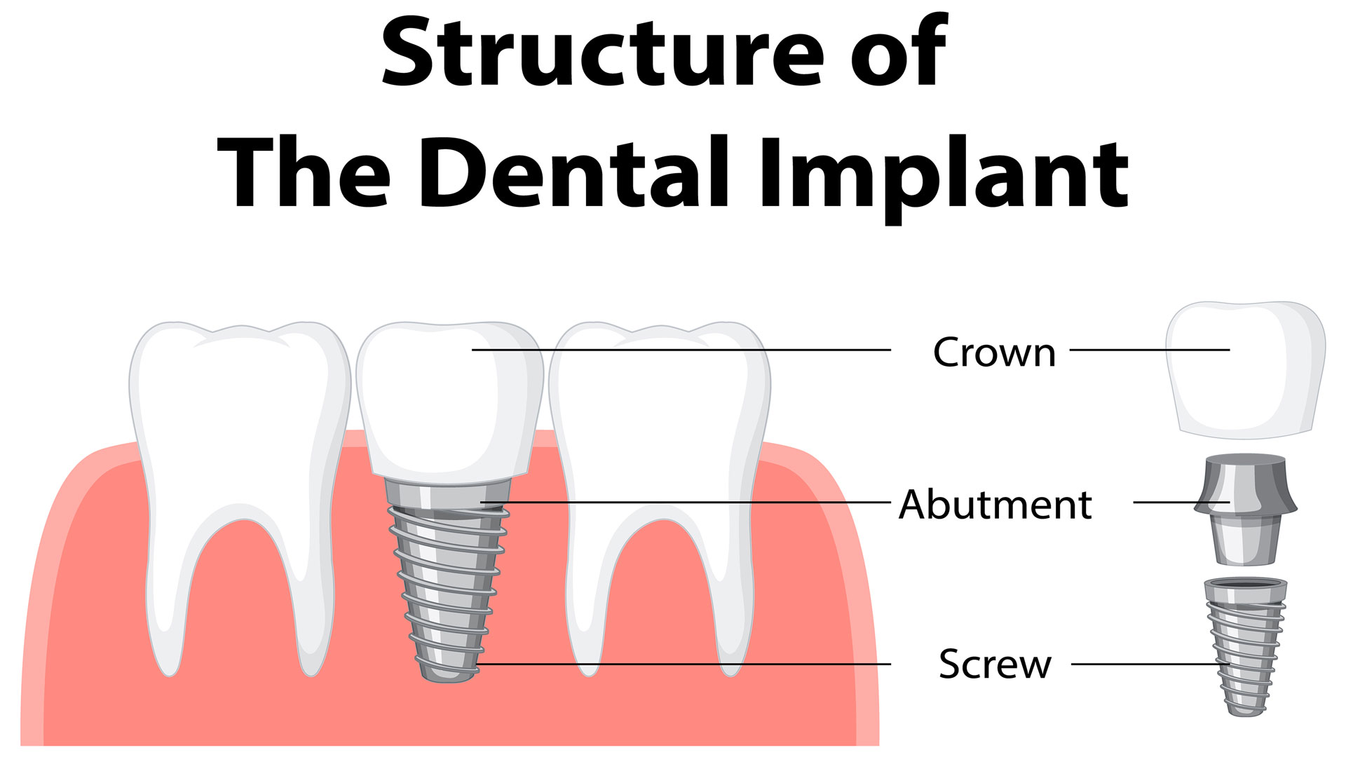 How To Get Dental Bridges For Front Teeth? Restore Confidence