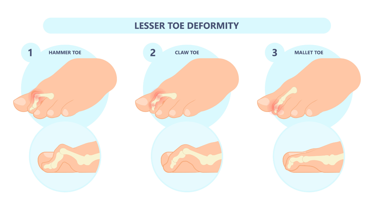 How To Get Rid Of Crooked Toes Woman S World