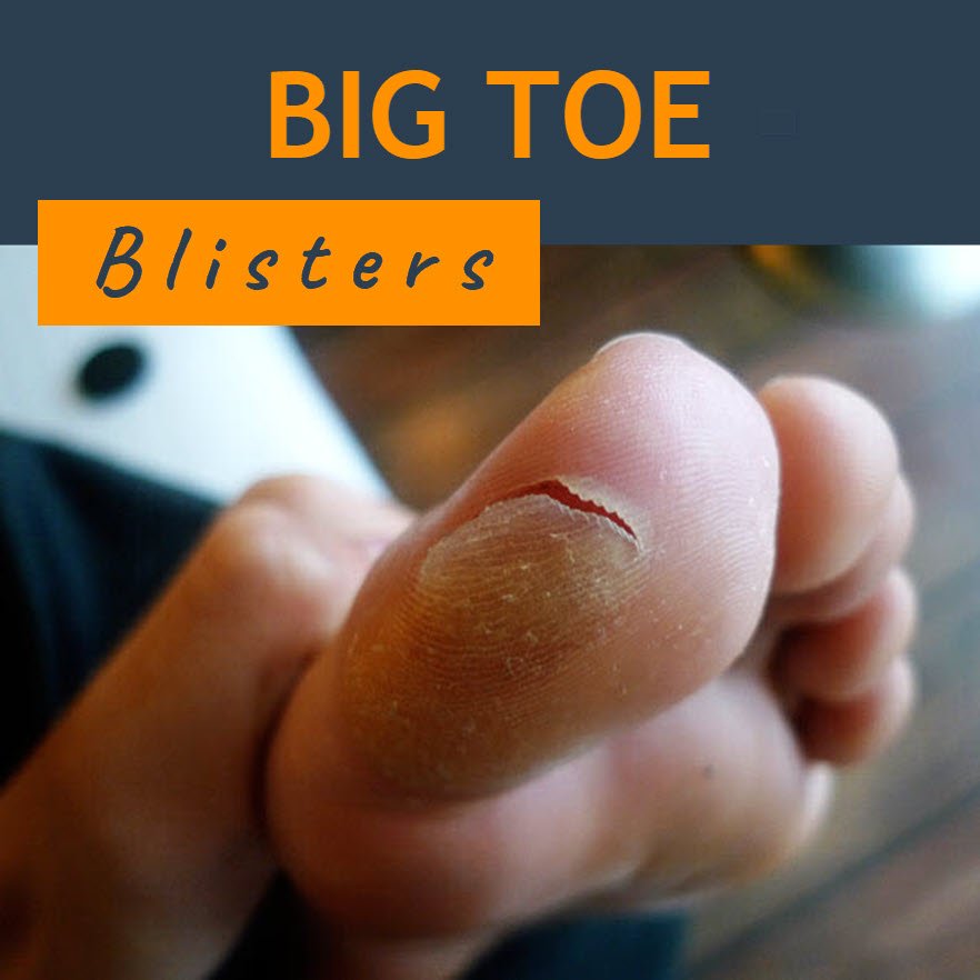 How To Heal Red Blood Blister Mouth? Quick Remedies