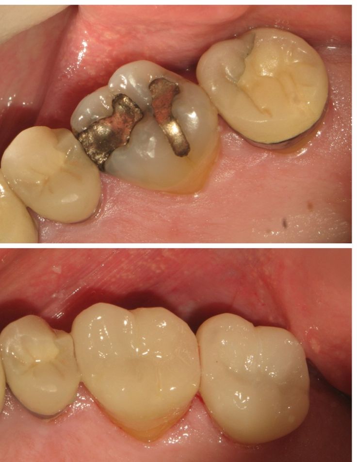 How To Prevent Cavity Fillings From Falling Out? Tips Inside