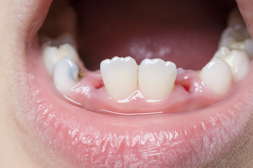 How To Prevent Dry Socket After Tooth Extraction?