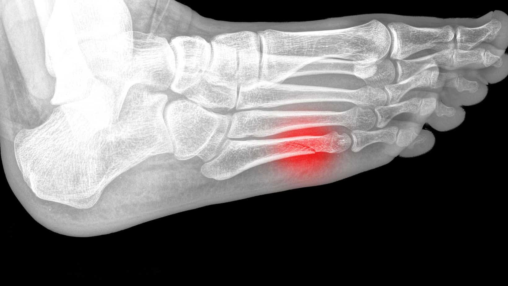 How To Rehab A Broken 5Th Metatarsal? Simple Exercises