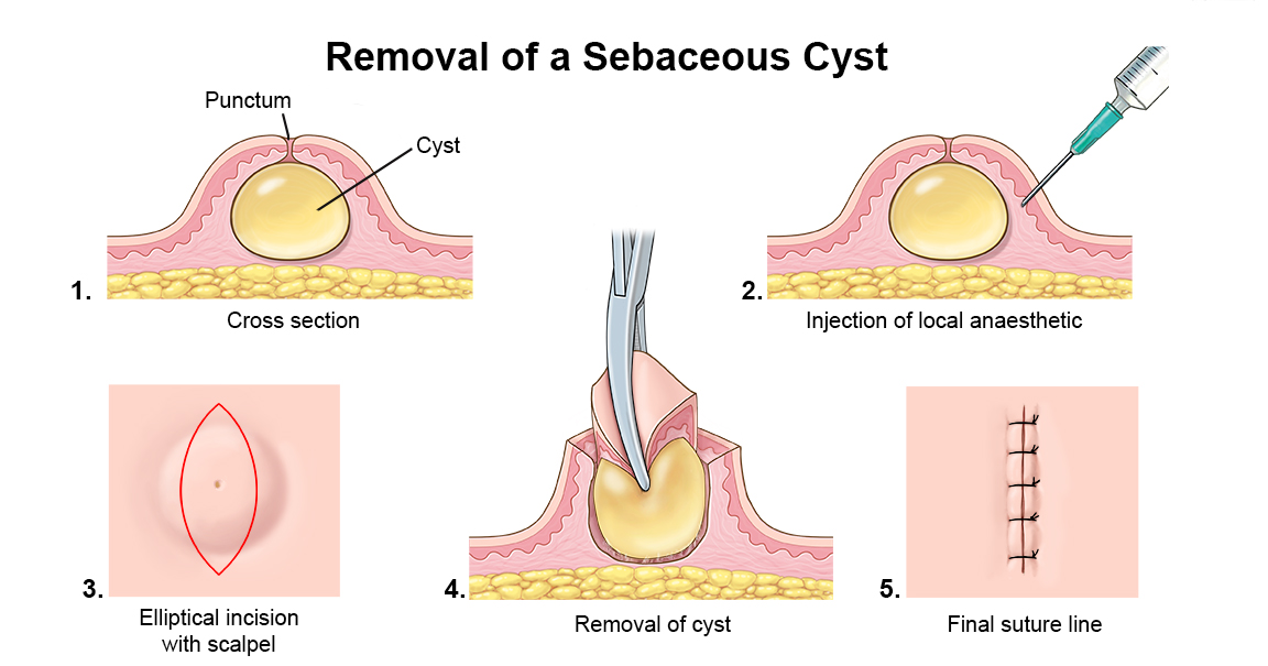 How To Remove Labia Cyst? Safe Removal Methods