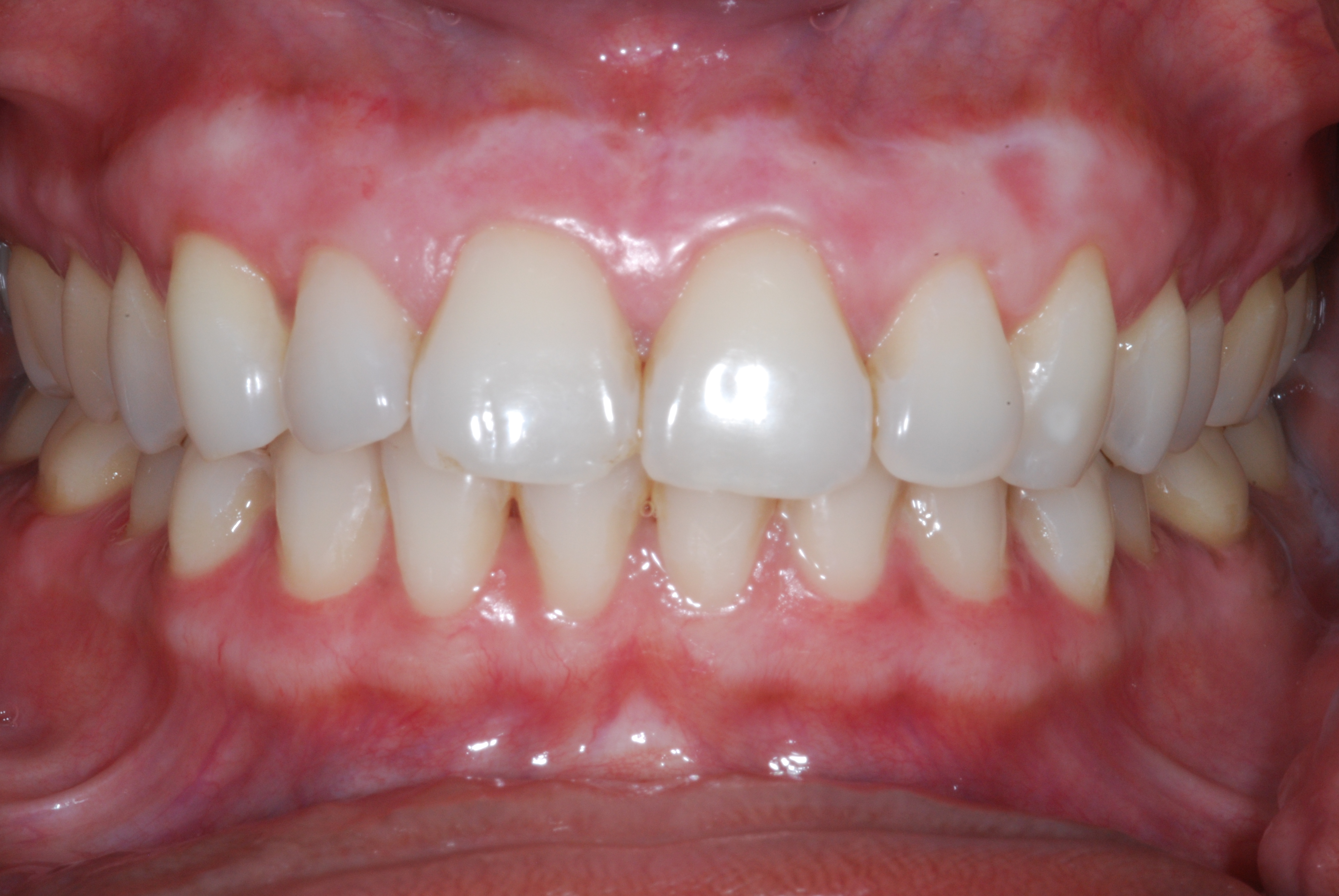 How To Remove White Spots On Teeth After Whitening?