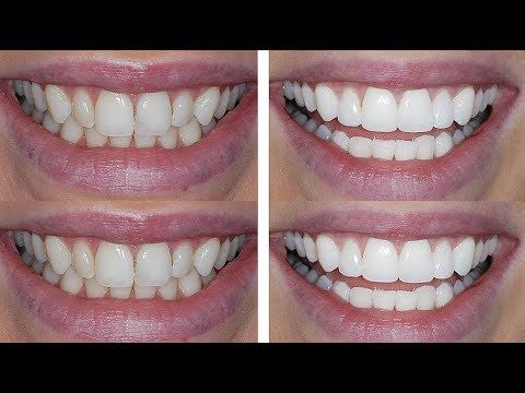 How To Shave Teeth Down? Painfree Solution