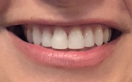 How To Soothe Burned Gums? Whitening Relief Tips