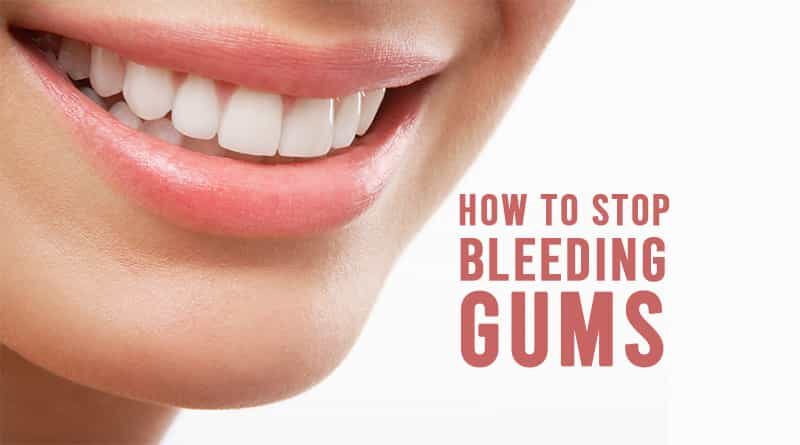 How To Stop Anemia Bleeding Gums? Fast Relief Tips How To Stop Anemia Bleeding Gums? Fast Relief Tips