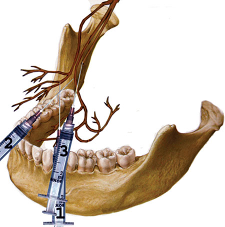 How To Stop Inferior Alveolar Nerve Pain? Expert Solutions