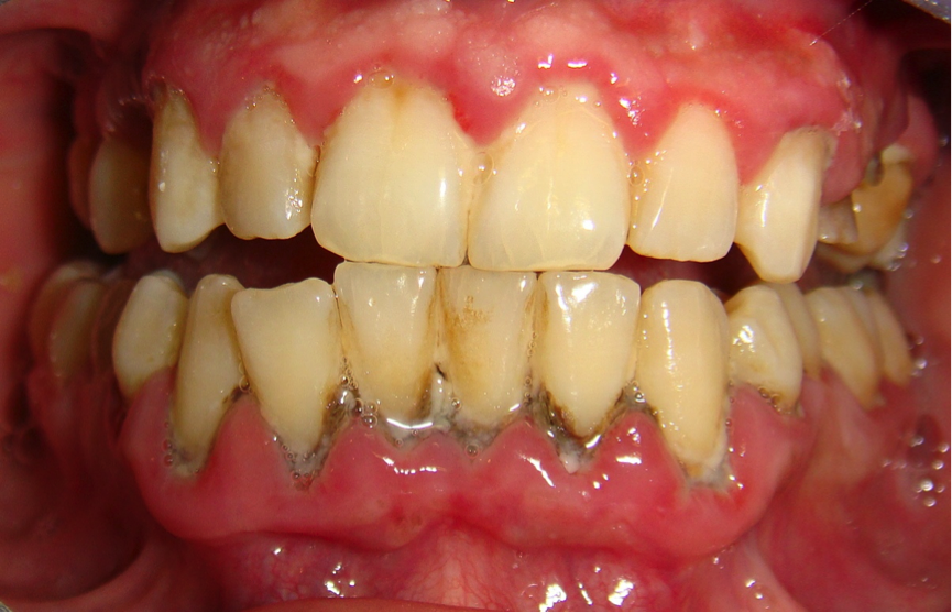 How To Stop Teeth Turning Green? Natural Remedies Inside