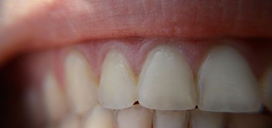 How To Stop Teeth Whitening Gum Burn? Fast Remedies
