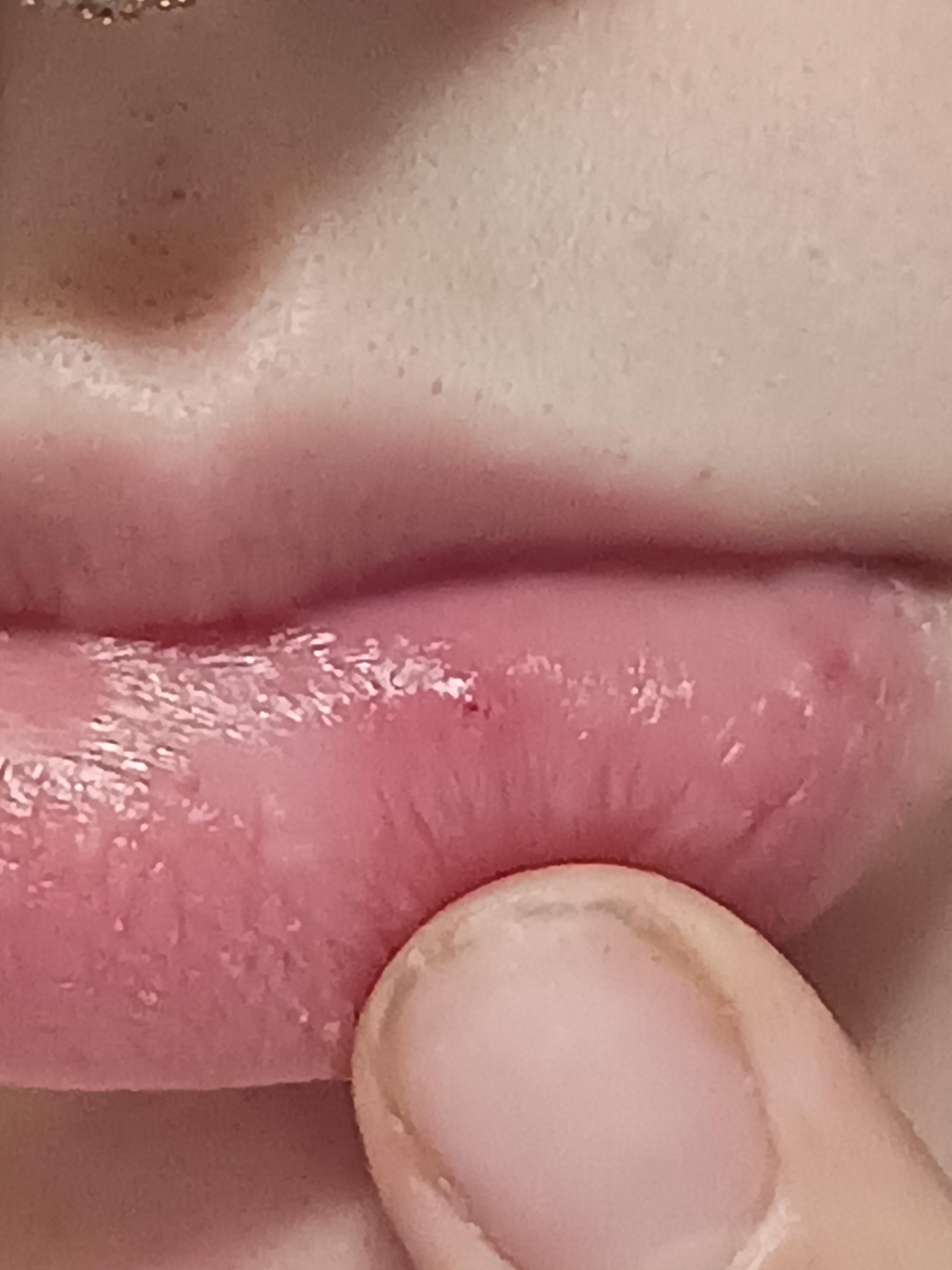 How To Treat Blackhead Inside Mouth? Fast Relief