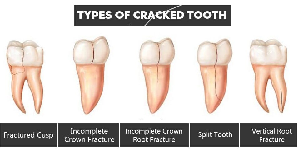 How To Treat Cracked Tooth With Cavity? Easy Solutions