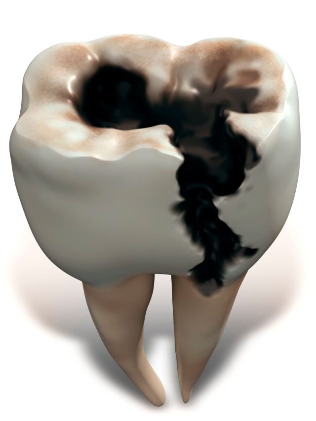 How To Treat Decayed Wisdom Tooth? Painfree Solutions