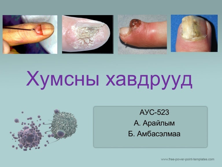 How To Treat Nail Tumor? Symptom Solutions