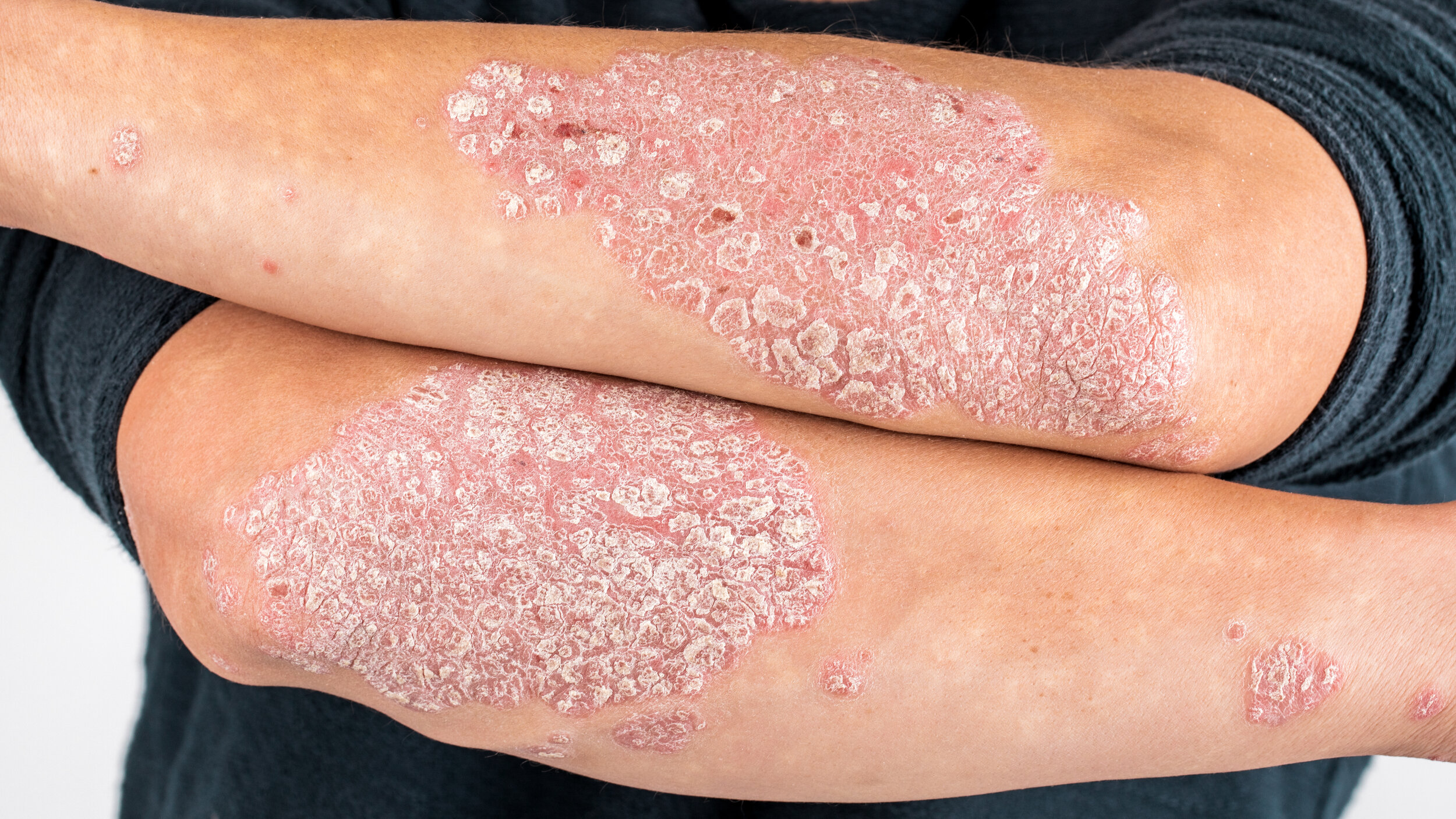 How To Treat Psoríase Na Cabeça? Effective Remedies