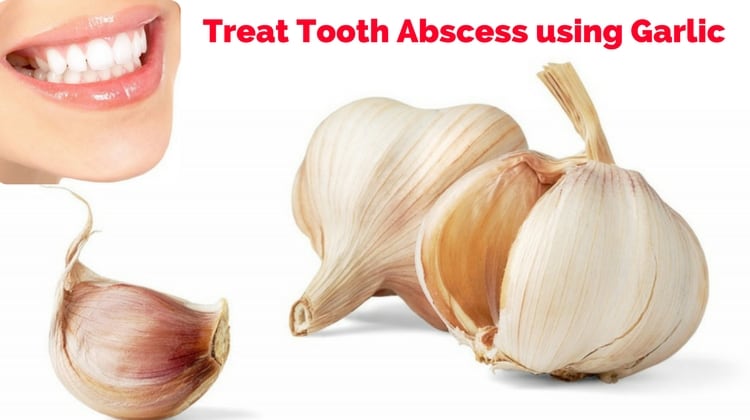 How To Treat Tooth Abscess Using Garlic How To Treat Tooth Abscess Using Garlic