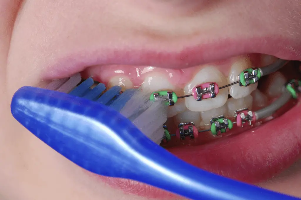 How To Use Small Toothbrush With Braces? Effective Tips How To Use Small Toothbrush With Braces? Effective Tips