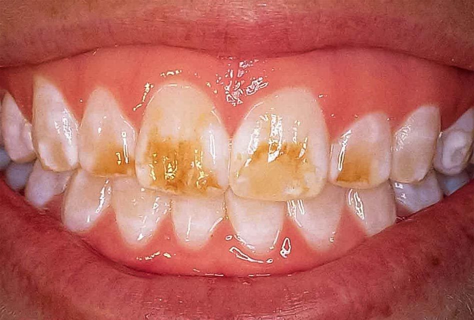 Hypocalcification Of Teeth Hypocalcification Of Teeth