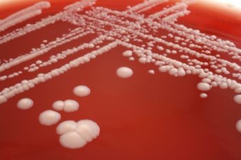 Hypothyroid Yeast Infection Relief