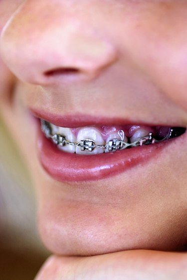 I Can't Afford Braces