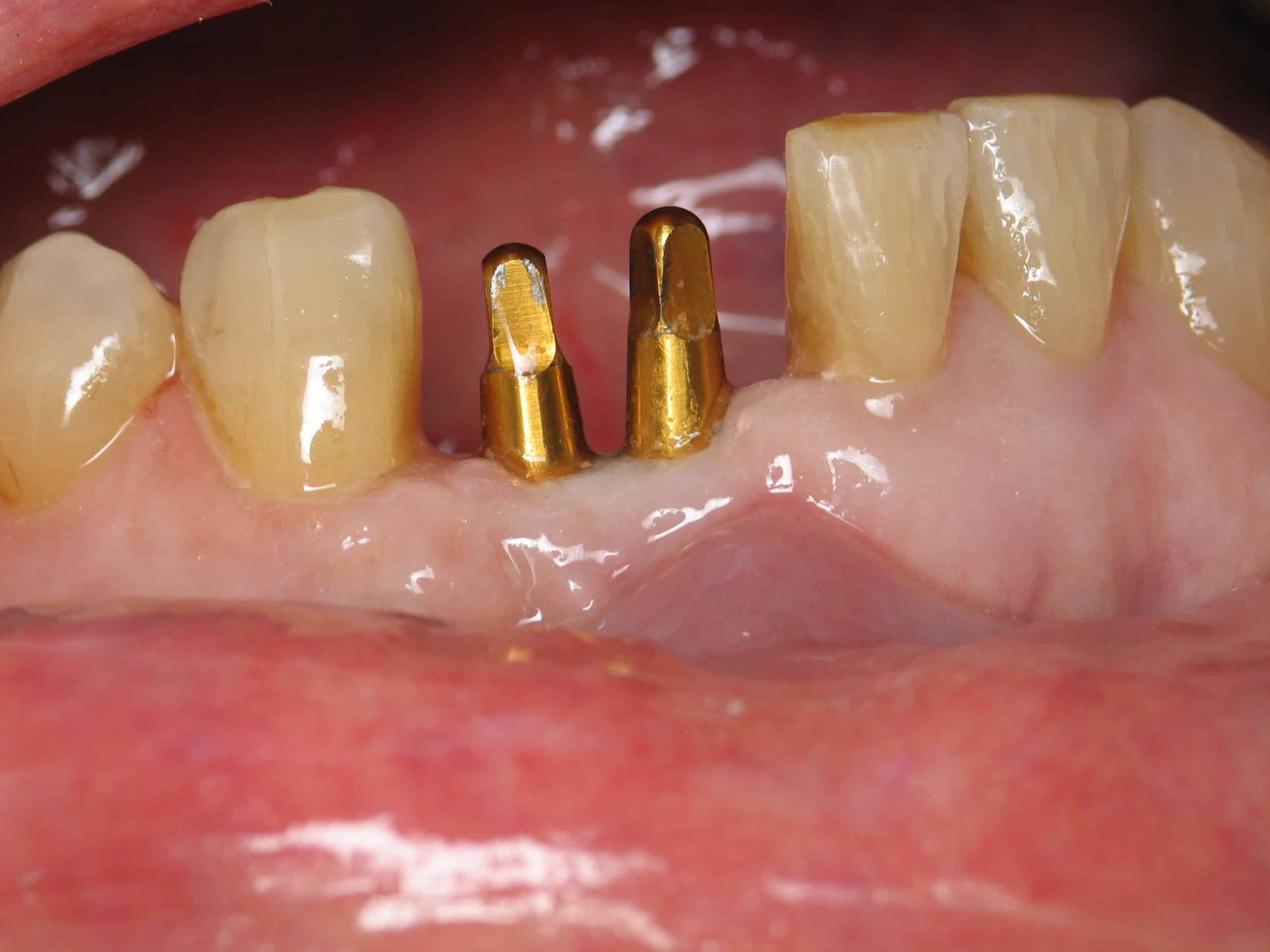 Implants On Front Teeth