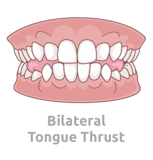 Infantile Tongue Thrust Infantile Tongue Thrust