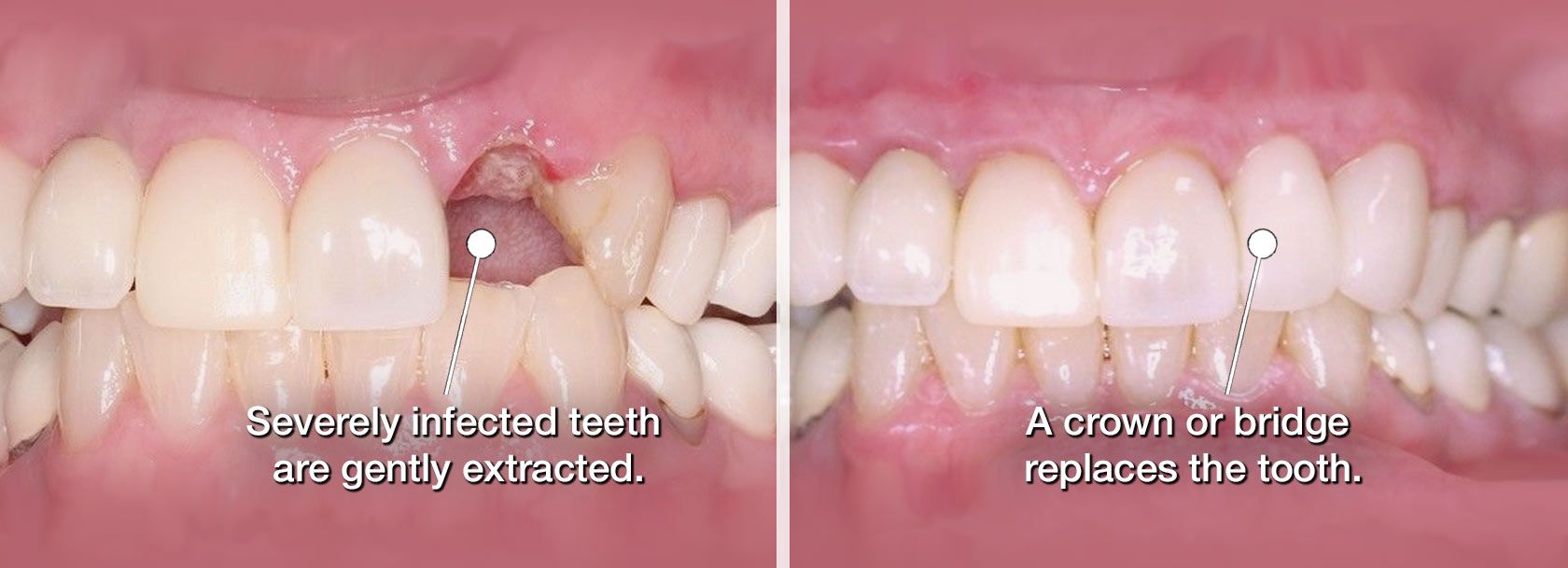 Infected Gums After Tooth Extraction
