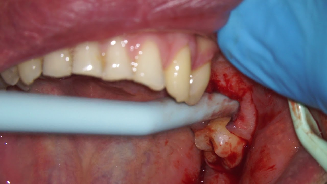 Infected Tooth Removal