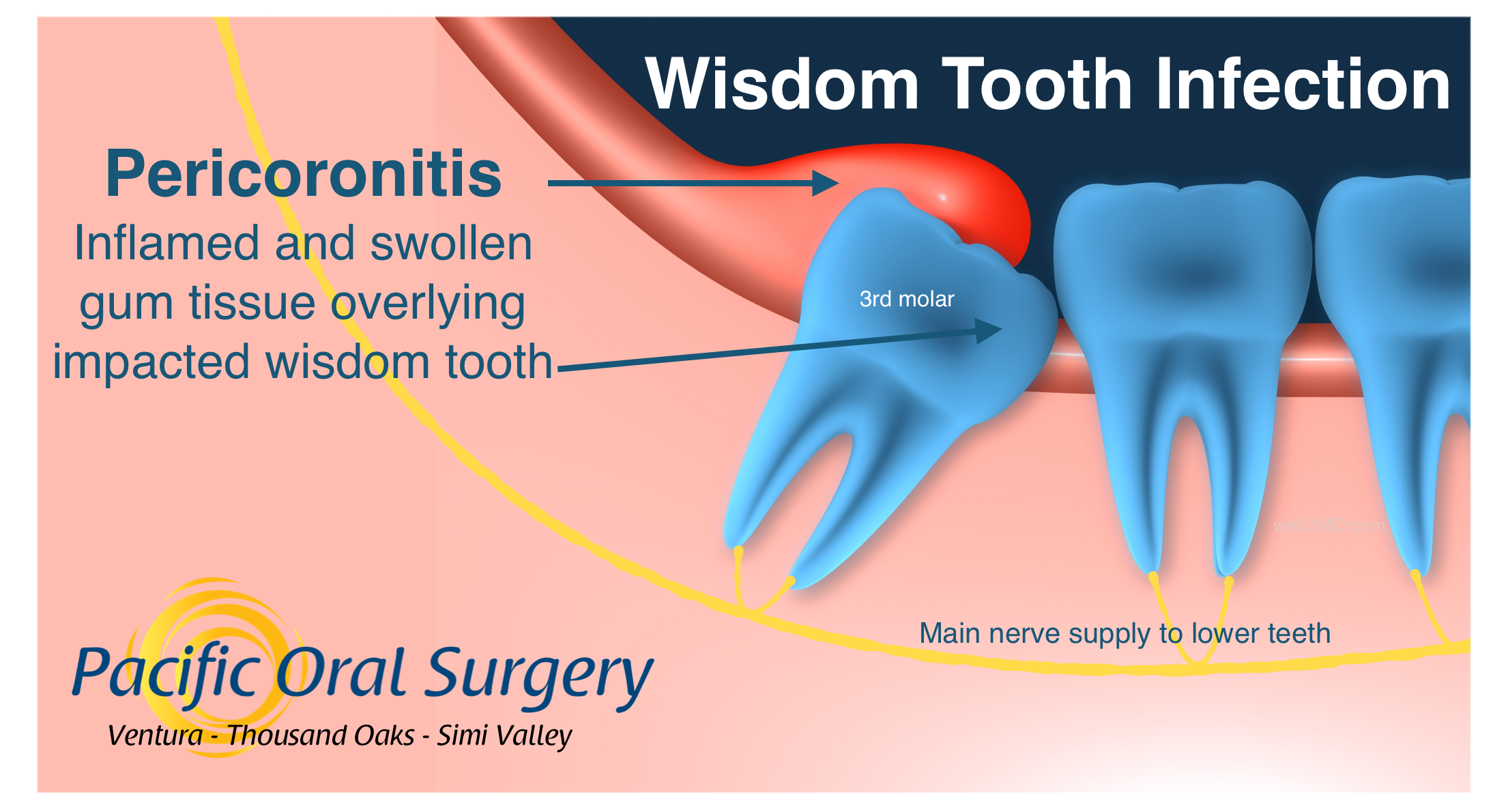 Infection At Tooth Extraction Site