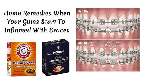 Inflamed Gums Braces