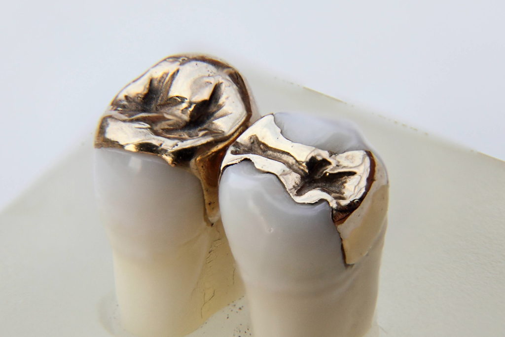 Inlay Dental Definition