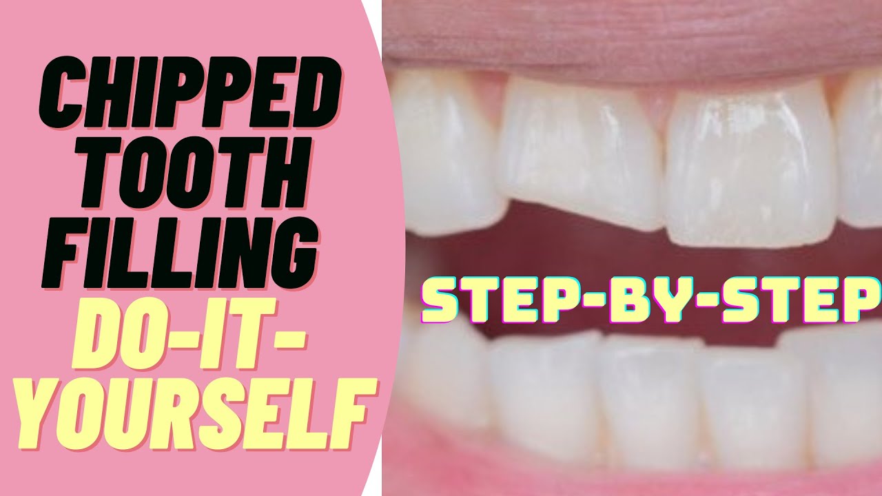 Inlay Tooth Filling: Fix Decay With Durable Results Inlay Tooth Filling: Fix Decay With Durable Results