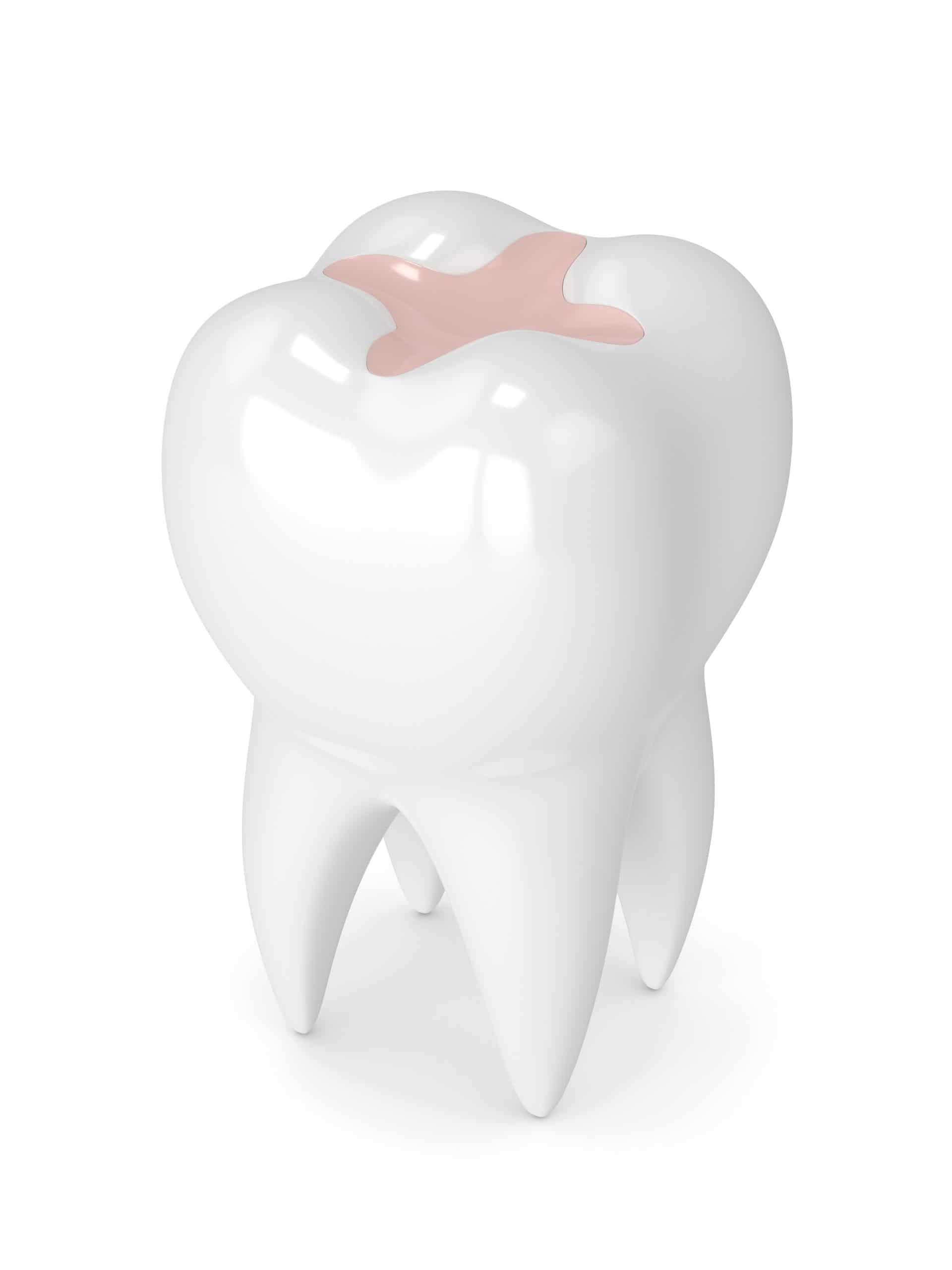 Inlay Tooth Filling: Restore Smiles Naturally