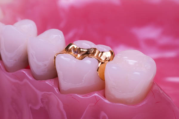 Inlay Tooth Filling