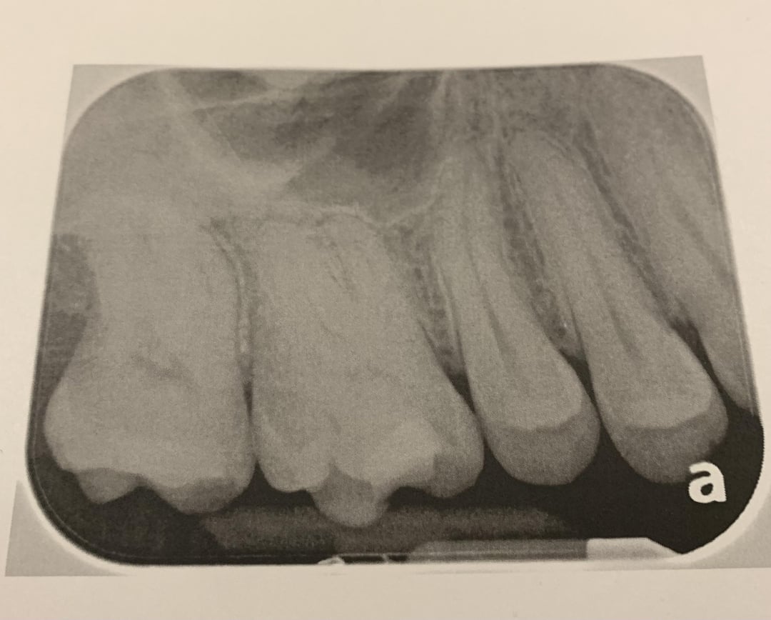Intermittent Tooth Pain