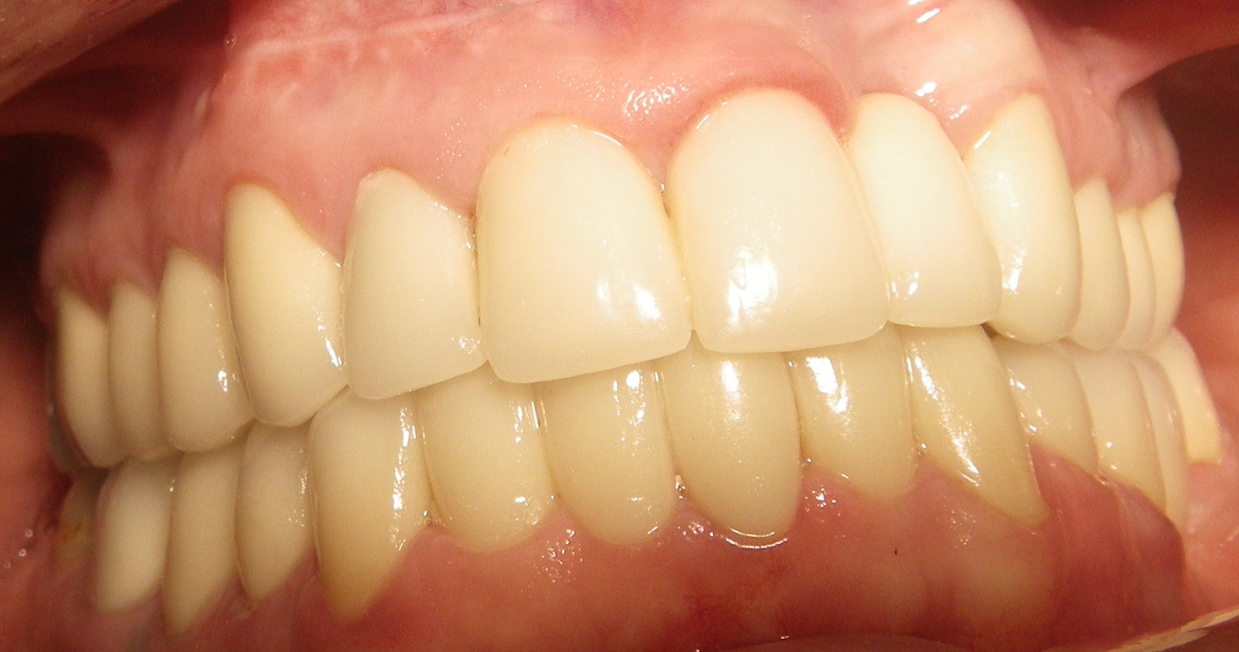 Intrinsic Tooth Staining